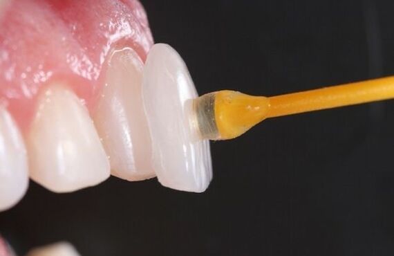 An ultra-thin laminate made using zirconia- ジルコニアを使用した極薄ラミネート、歯科技工所をお探しでしたらイメージプロダクツツーエイティーン