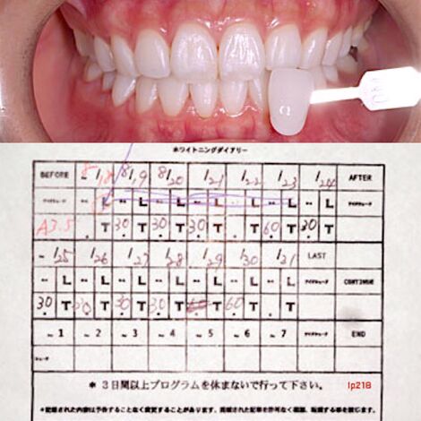 １７，ホワイトニング